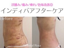 オリエンタルローザ 表参道(Oriental Rosa)/お腹脂肪インディバアフターケア