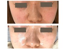 レクラ バイ ドクターエイチ(L'ECLAT by Doctor.H)/無針水光注入”美容液真皮導入”