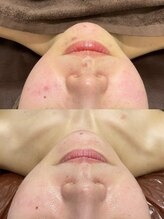 チェルト 鈴鹿店(CERTO)/赤み・黒ずみ・肌荒れ