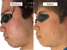 イーサム 高槻摂津富田店(e-sam)/髭脱毛