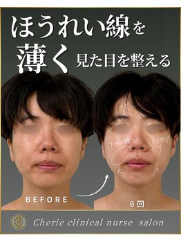 シェリー(Cherie)/深くなってきたほうれい線を薄く