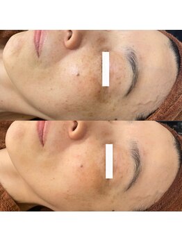 エスクリア 梅田北新地店(S.CLEAR)/月2回のサロンケア