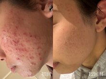 ウォーム(warm)/ニキビケア/肌荒れ/ニキビ肌