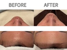 ライム 立川(LIME)/ハーブピーリング｜美白