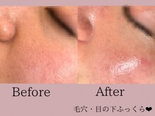 ミスティビオ 平尾店(mistyBIO)/《毛穴ケア》