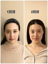 シャムリー(SHAMRY)/切らずに上がる究極のたるみケア