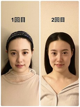 シャムリー(SHAMRY)/切らずに上がる究極のたるみケア