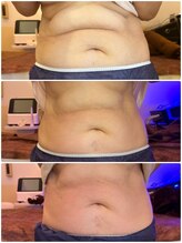 マボーテハル/脂肪分解、脂肪燃焼、吸引EMS