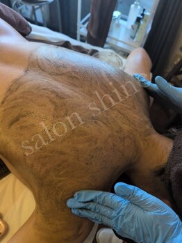 サロンシャイン(Salon Shine)の写真/圧倒的症例数！ハーブピーリングで艶肌へ！！背中のお手入れ充実してます。