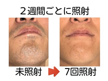 エビアス 旭川豊岡(evias)/メンズ店　大人気！ヒゲ脱毛♪