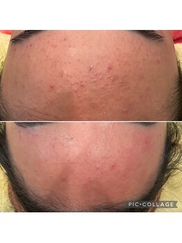 ルナート(Lunart)/ハーブピーリング【顔】ニキビ悩