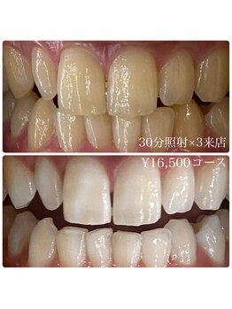 ホワイトニングルーム 横浜店(Whitening Room)/ホワイトニング/横浜