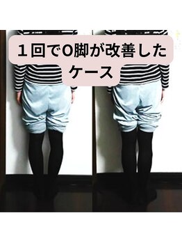 ベルフィオーレ/１回でO脚が改善したケース