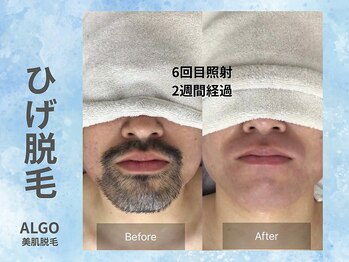 アルゴ 山口宇部店(ALGO)/頑固な髭も6回でこの仕上がり!