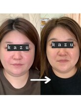 トータルヘルスビューティーカズ(TotalHealthBeauty KAZU)/【小顔矯正】光の森/光美容