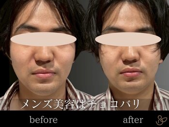チョコバリ 恵比寿店(chocobari)/小顔リフトアップ（美容鍼）30代