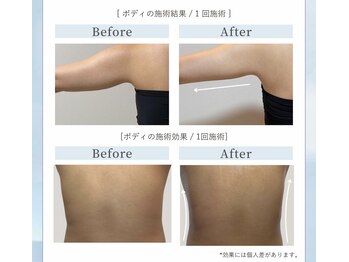 アトリス(Atriz)の写真/広島初導入！インコアシェイプで二の腕やはみ肉のお悩みを整え即実感できる体験を♪