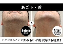 RBL イオンモール盛岡店/メンズ脱毛/ヒゲ脱毛1回目剃毛後