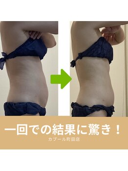 カブール 町田店/本当に1回での痩身結果です！
