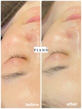 ピアーノ(PIANO)/エルモサハーブピーリング