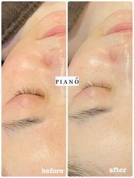 ピアーノ(PIANO)/エルモサハーブピーリング