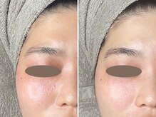 カプリス(CAPRiCE)/ホワイトスノーピール