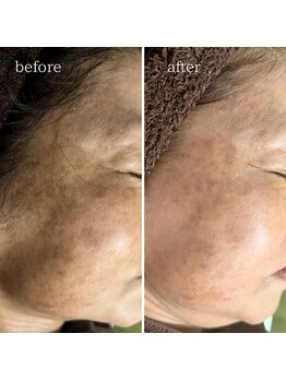 マーギアー(Magier)/ハーブ＋ダーマ　初来店→６回目