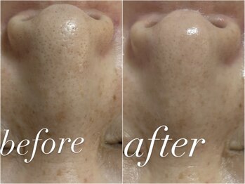 フォー(For...)/肌質改善・毛穴ケア◇ララピール