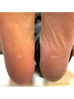 ファレノホワイト/足裏角質除去でツルふわ踵