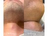 【好評により延長】メンズ顔（ヒゲ）脱毛1年間通い放題¥66,000→¥30,000