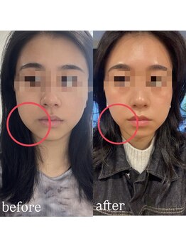 ビューティーサロン プティ(beauty salon petite)/レモンボトル脂肪分解！速攻小顔