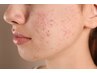 【大人ニキビのためケア】