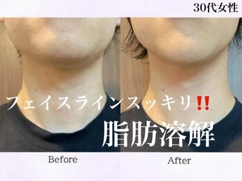 エステの森ジュジュ/脂肪分解フェイスライン