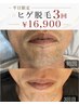【平日限定】抜ける!ヒゲ脱毛3回 ¥16,900(顔全体+首込)洗顔パック付☆