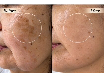 ハクビューティー(HAKU BEAUTY)の写真
