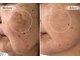 ハクビューティー(HAKU BEAUTY)の写真