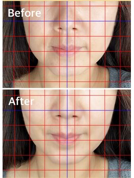 ハリキュア(Hari-Cure)/美容鍼のBefore・After