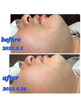 アンレーヴ/顔ひげ脱毛