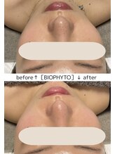 ベルティーク(BELTHEQUE)/ビオフィート/ハーブピーリング