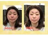 【小顔矯正×美容鍼】60分コース　11,500円 ⇒ 7,980円