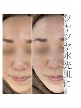 バーグトータルビューティー(bague total beauty)/ヒト幹細胞注入でお肌のハリUP