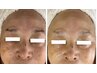 【40・50代　シワたるみ改善】ハーブピーリング×ケアマッサージ80分￥18000