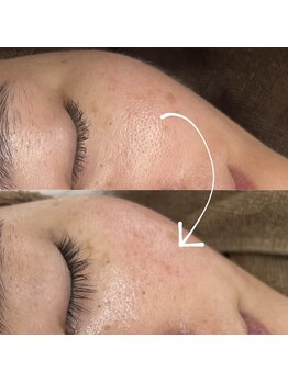 ベリスユイット(BELLIS HUIT)/【剥離ありハーブピーリング】