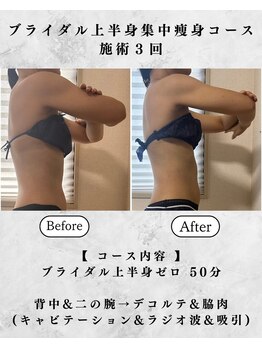 シーフェイス 横浜店(SEE FACE)/ブライダル二の腕はみ肉脇肉ケア