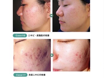 ディオーネ 西船橋駅前店(Dione)/幹細胞導入◇Before After 2