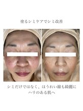 ルボン 宮崎店(RUBON)/自宅で塗るだけで!?塗るシミケア