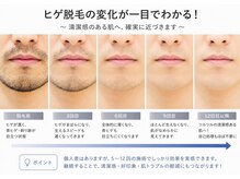 エイチビー(HB)/丁寧なカウンセリングで安心☆