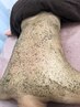 背中ケア全体【剥けないハーブピーリング】ＶＣＦ&パウダー0.5g美背中に♪