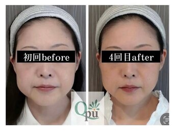 キュープ 大阪中百舌鳥店(Qpu)の写真/【小顔矯正+オイルケア+美顔器】で小顔専門店ならではの施術でほうれい線やたるみなども改善！！
