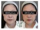 キュープ 大阪中百舌鳥店(Qpu)の写真/【小顔矯正+オイルケア+美顔器】で小顔専門店ならではの施術でほうれい線やたるみなども改善！！